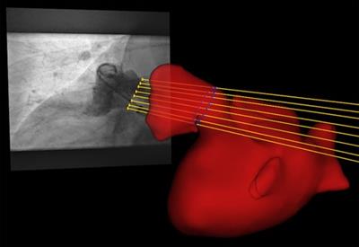 Cardiac magnetic resonance imaging for preprocedural planning of percutaneous left atrial appendage closure